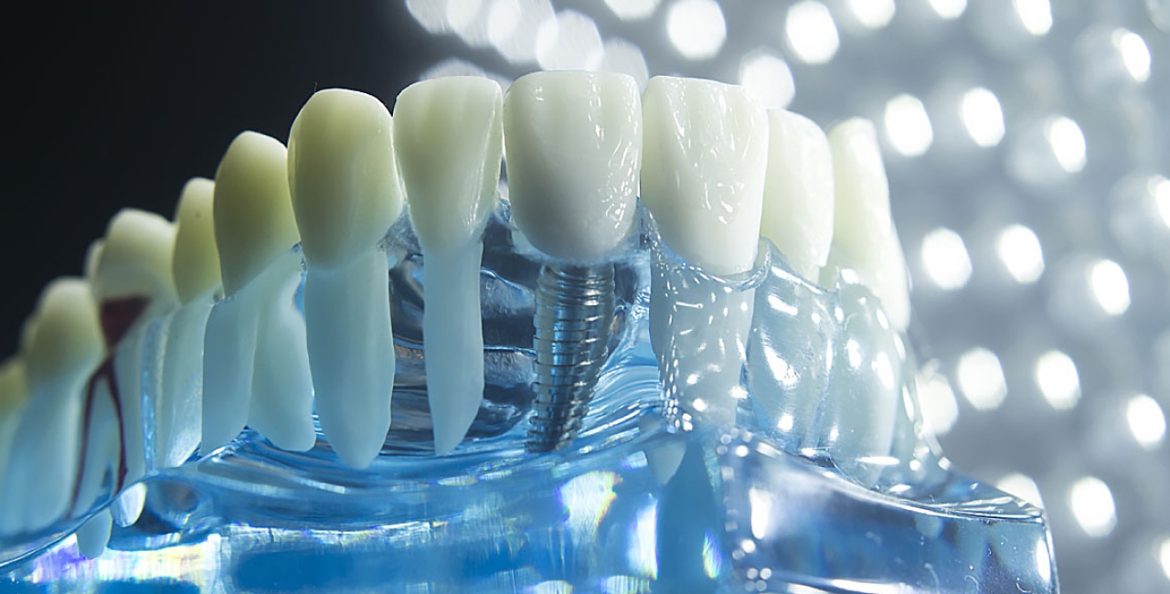 Protetske strukture na implantatima