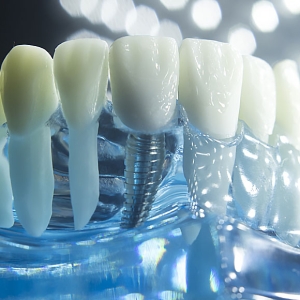 Protetske strukture na implantatima
