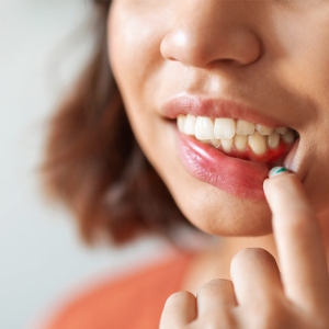 Gingivitis